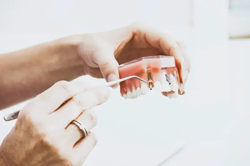 Person showing dental implant in artificial teeth